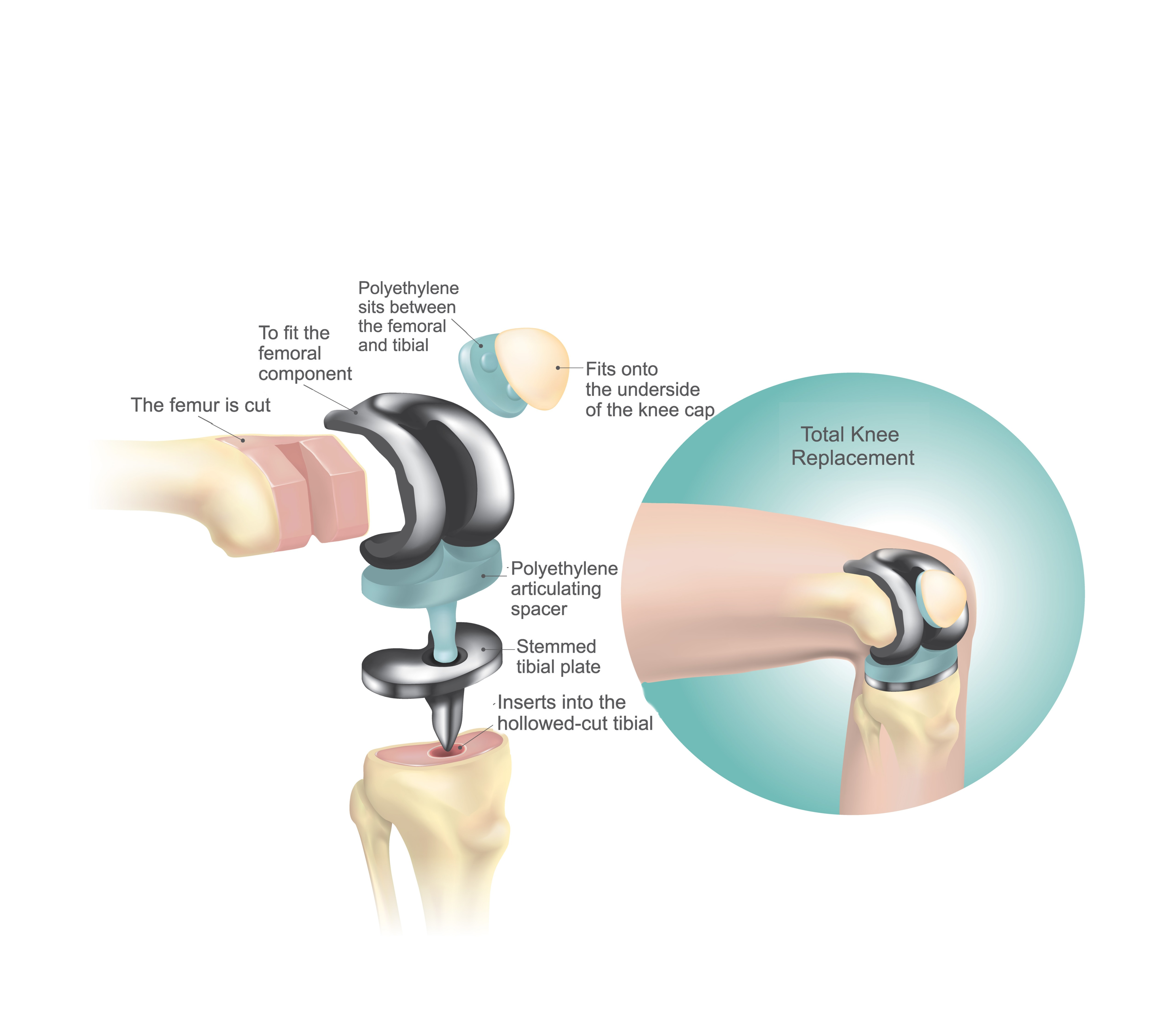 Revision Knee Arthroplasty