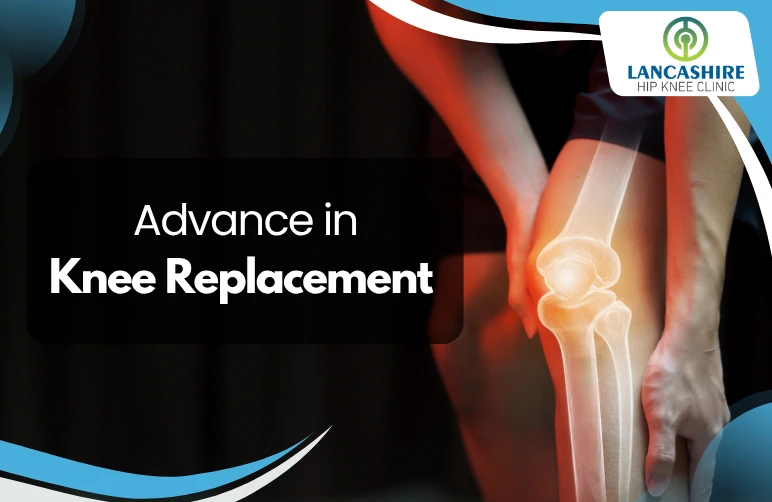 Advances-in-Knee-Replacement.webp